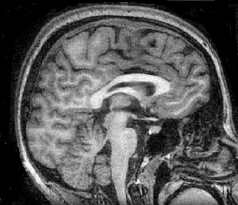 Image of brain from side