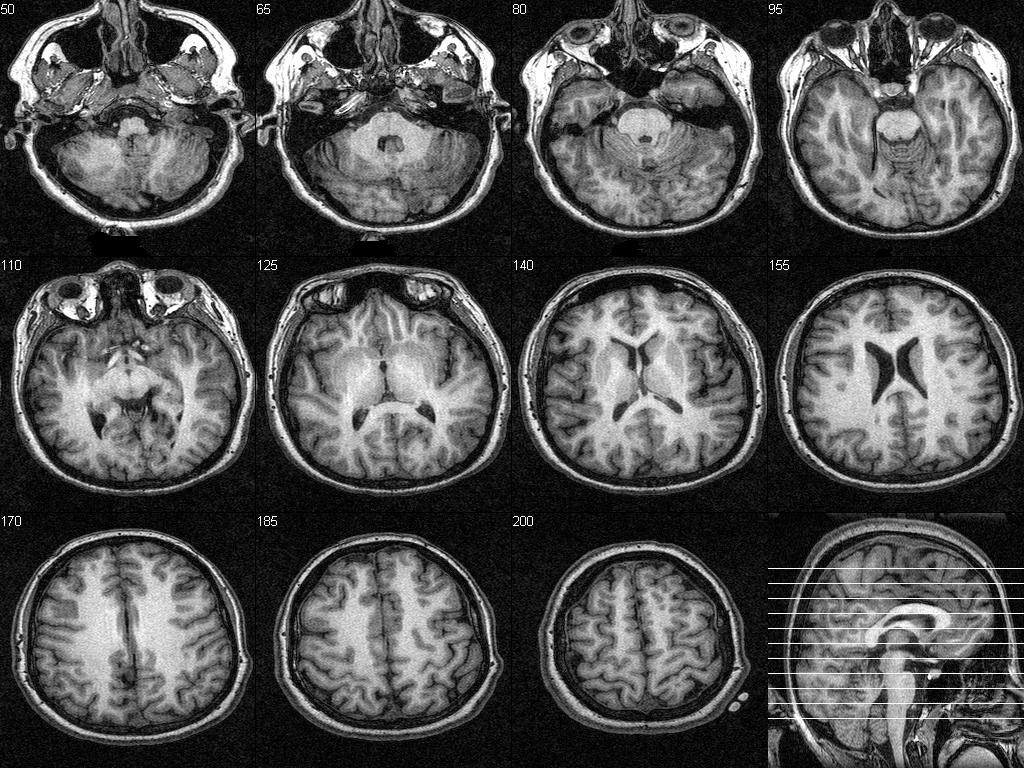 Image of 11 slices through brain